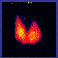 Scintigraphy of a hyperactive thyoroid