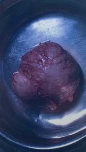 womb tumour